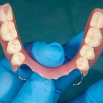 picture of partial dental appliance or partials