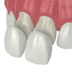 dental veneers illustration